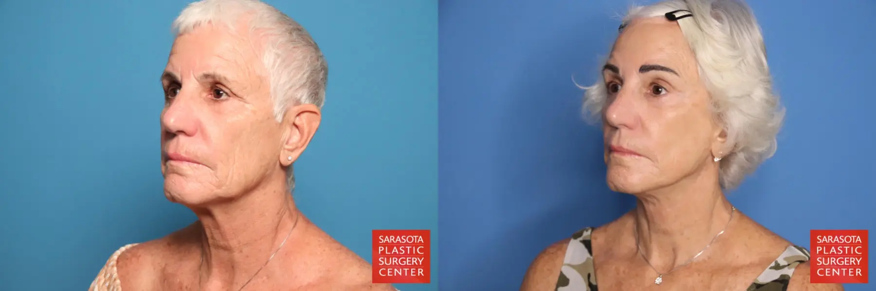 Facelift: Patient 52 - Before and After 2