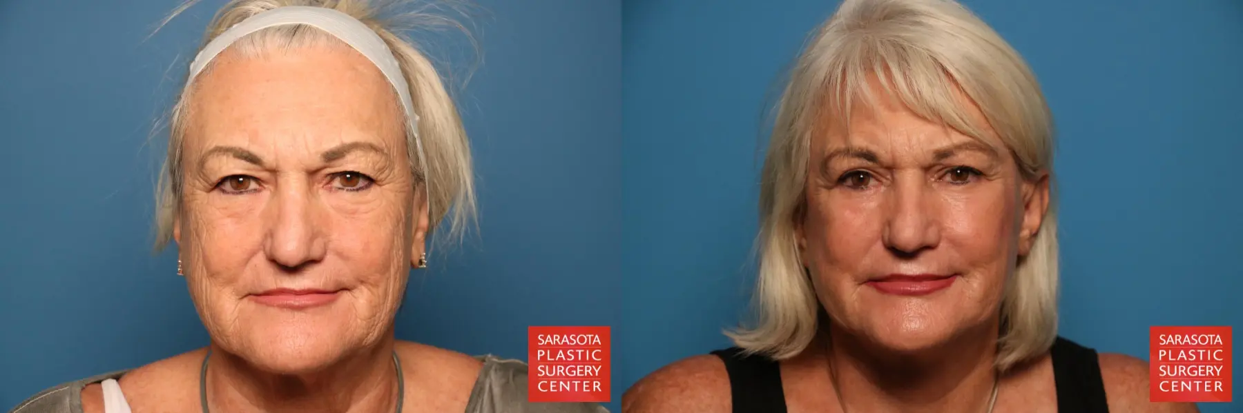 Facelift: Patient 14 - Before and After  