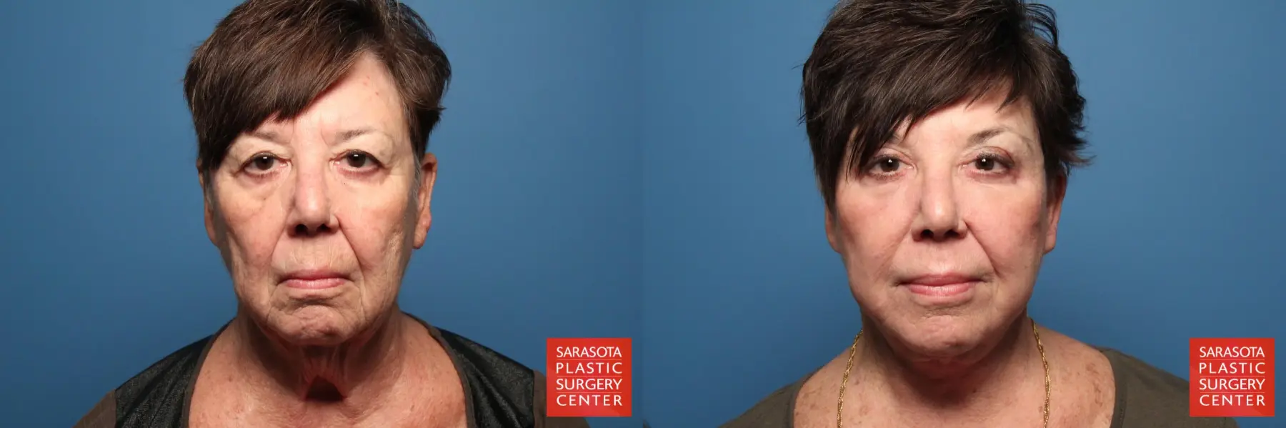 Facelift: Patient 24 - Before and After 1