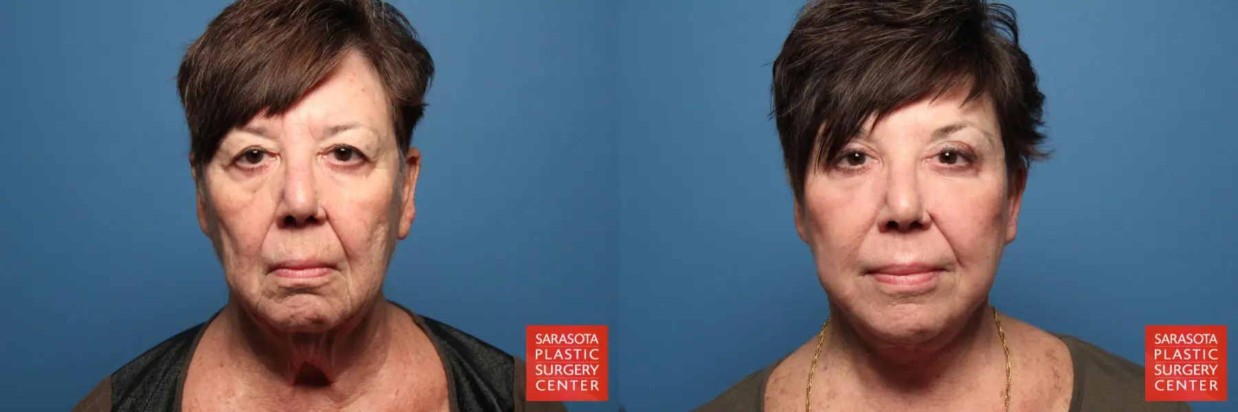 Facelift: Patient 24 - Before and After  