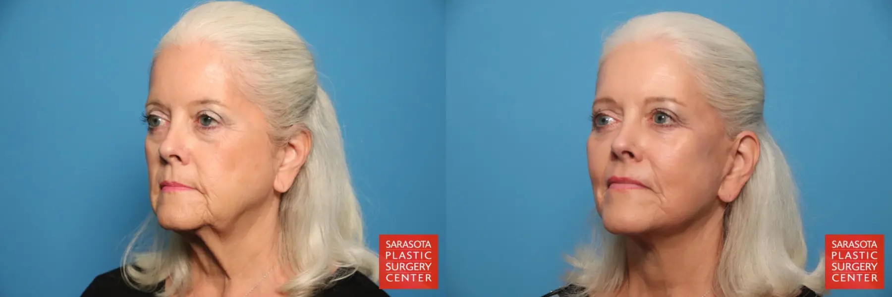 Facelift: Patient 62 - Before and After 2