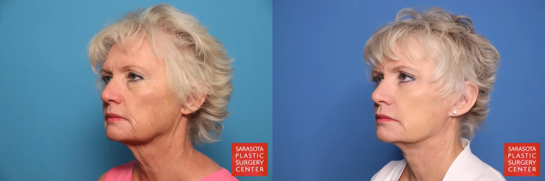 Facelift: Patient 53 - Before and After 2