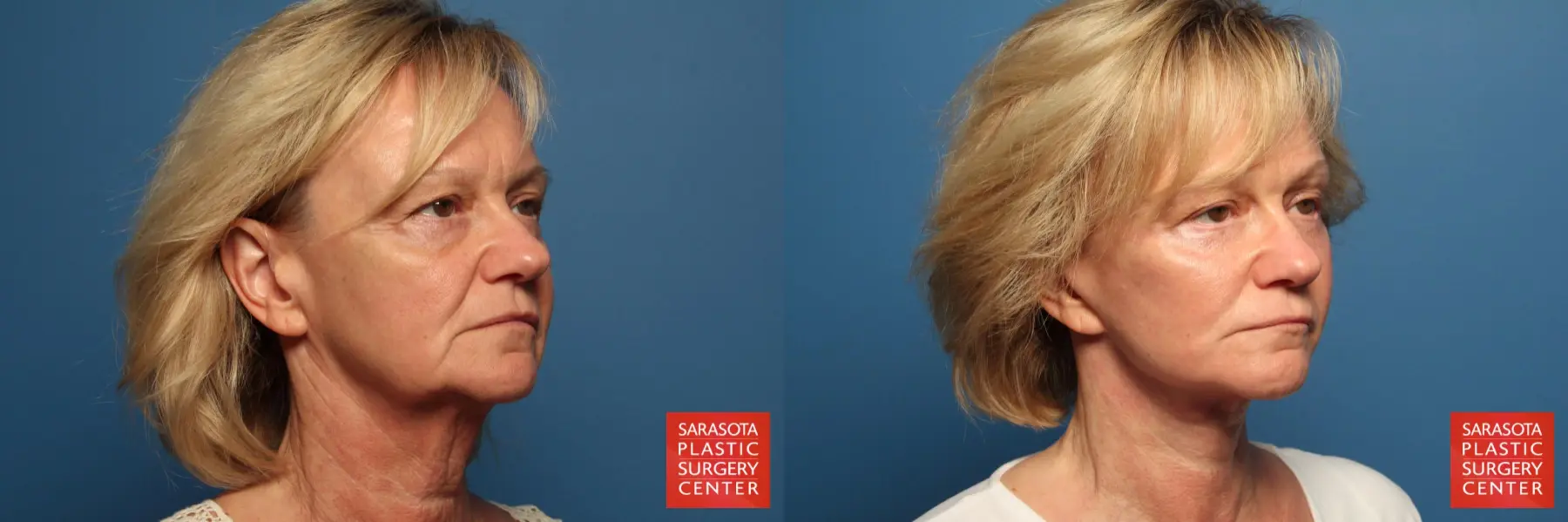 Facelift: Patient 28 - Before and After 2
