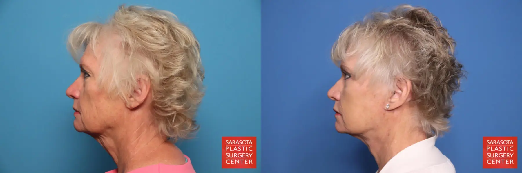 Facelift: Patient 53 - Before and After 3