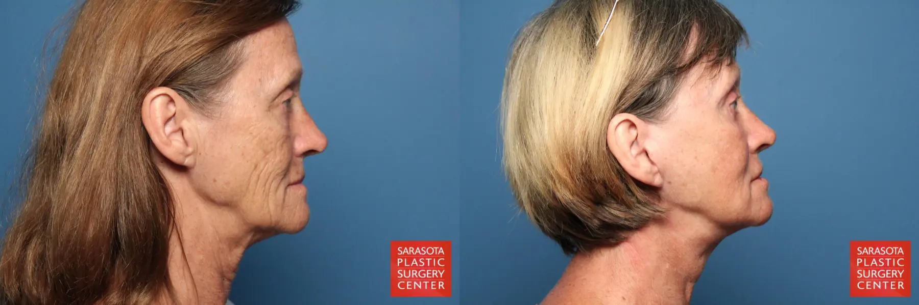 Facelift: Patient 30 - Before and After 3