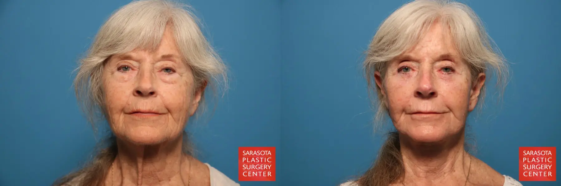 Facelift-revision: Patient 1 - Before and After  