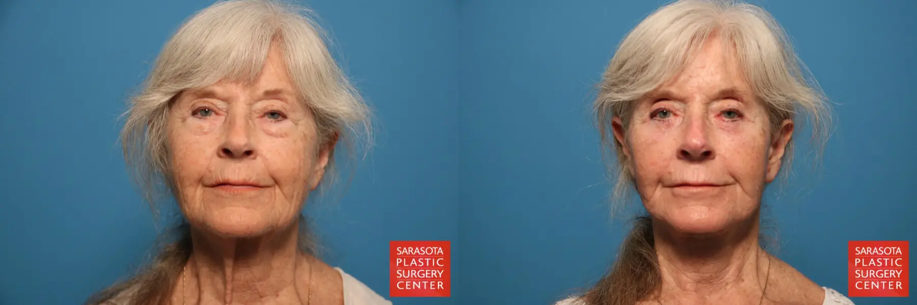 Facelift: Patient 10 - Before and After  