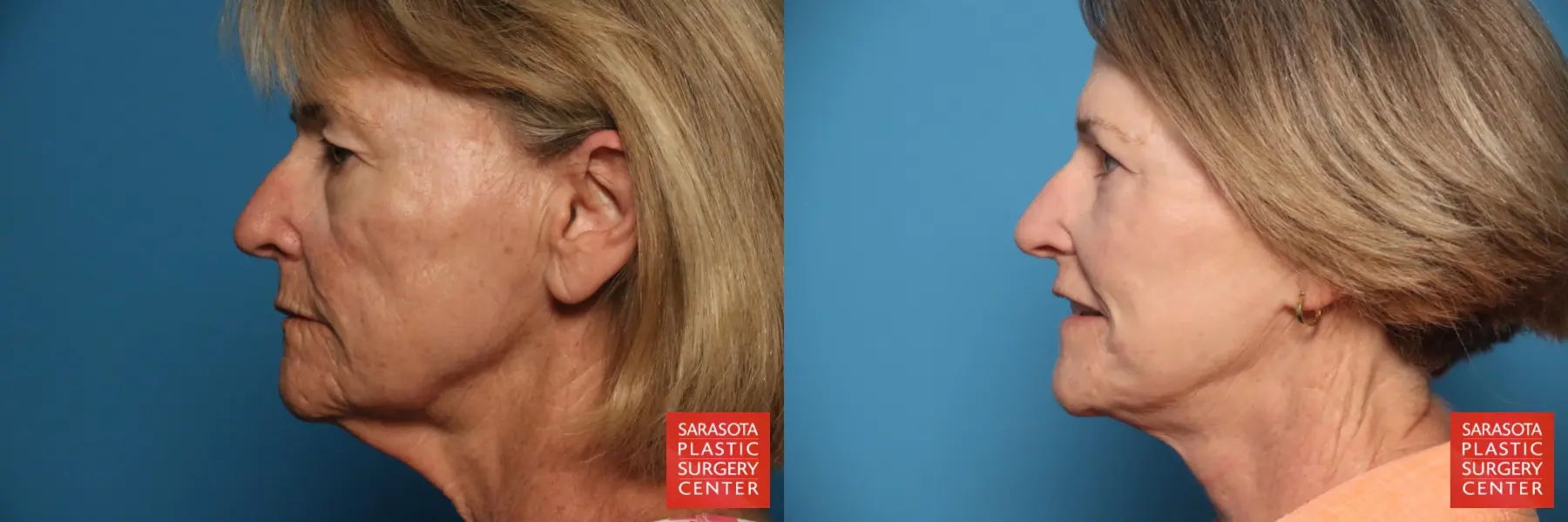 Facelift: Patient 64 - Before and After 3