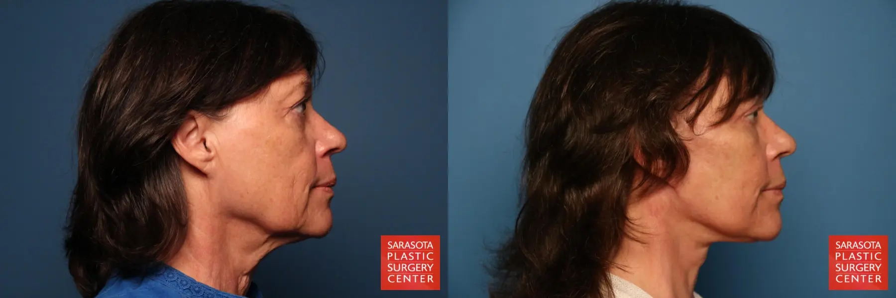 Facelift: Patient 14 - Before and After 5