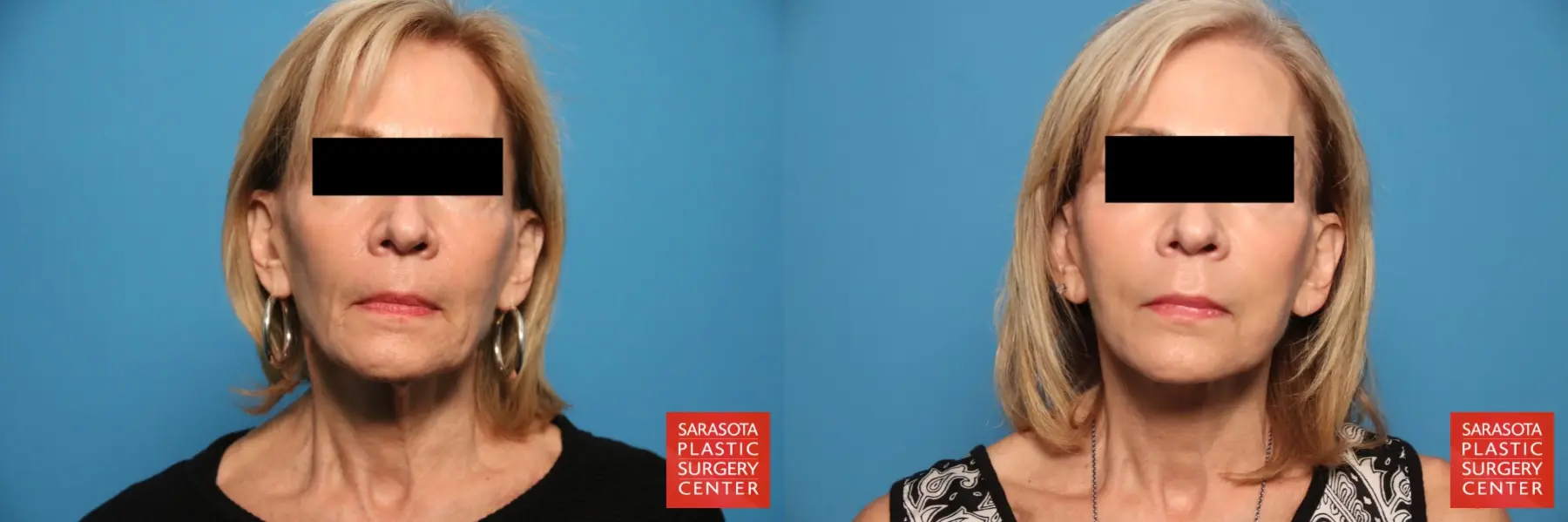 Facelift: Patient 67 - Before and After 1