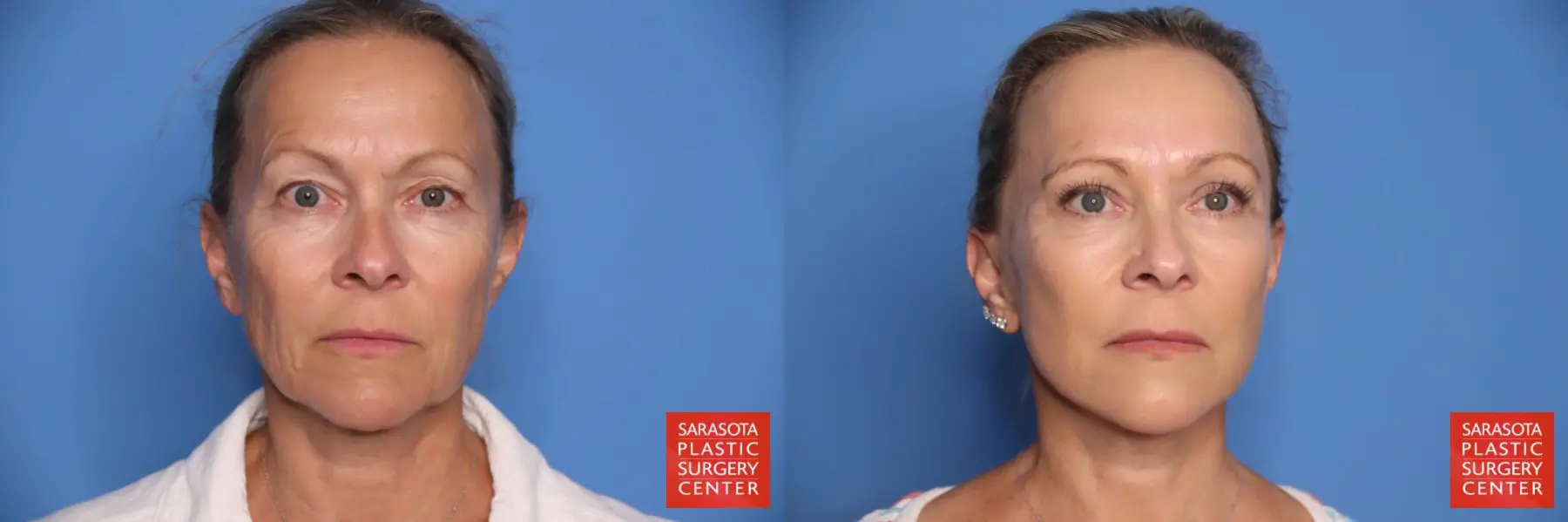 Facelift: Patient 54 - Before and After 1