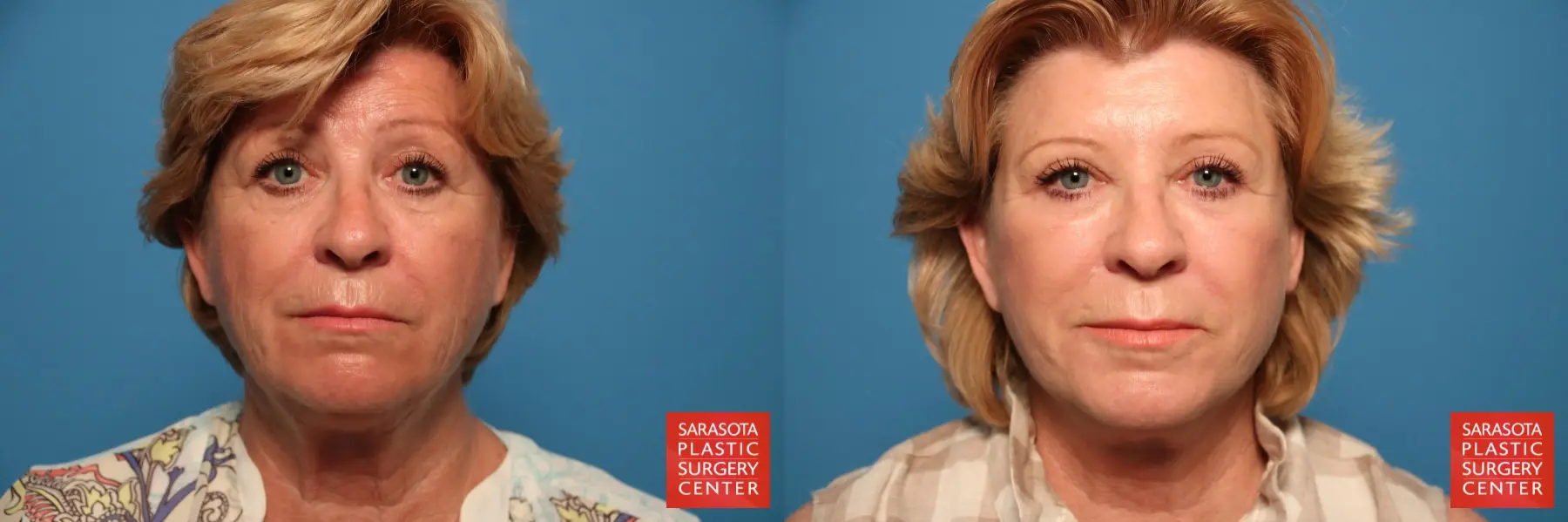 Facelift: Patient 26 - Before and After  