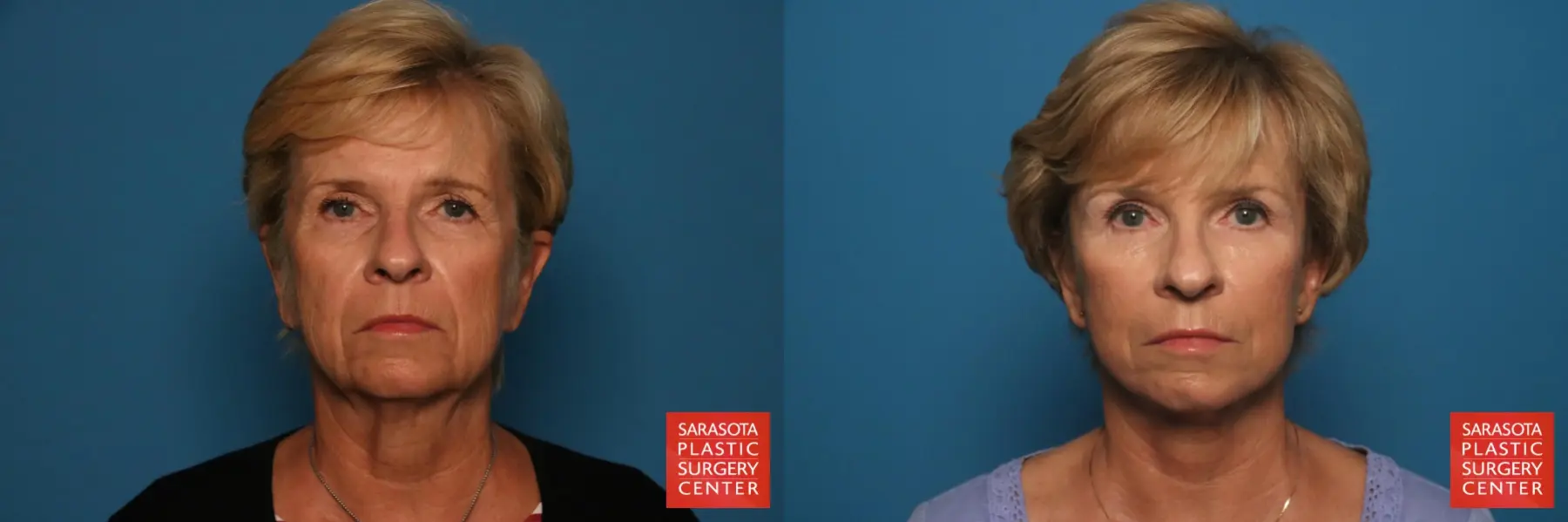 Facelift: Patient 55 - Before and After 1