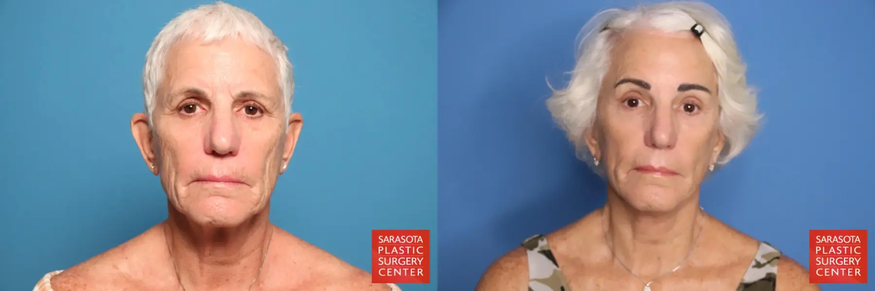 Facelift: Patient 52 - Before and After 1