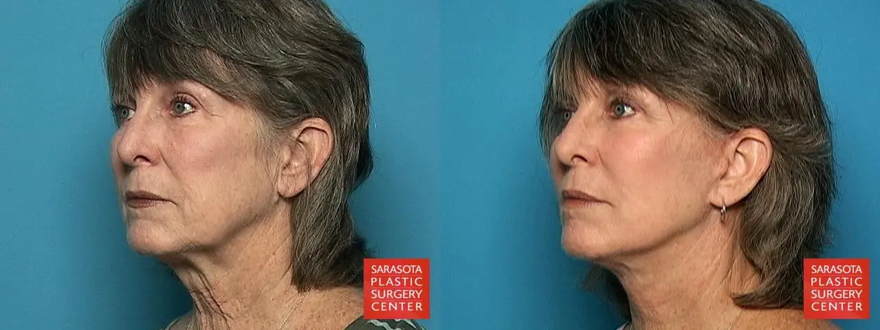 Facelift: Patient 19 - Before and After 2