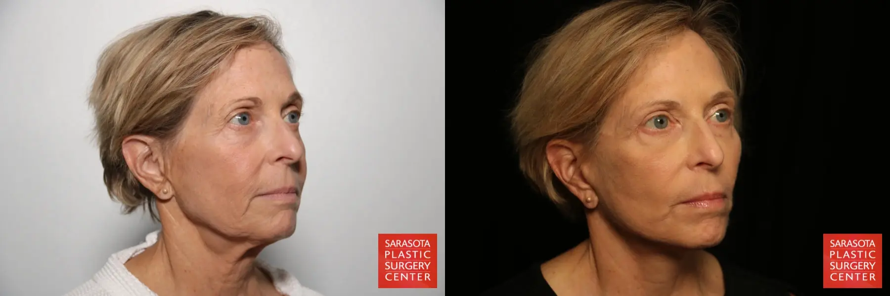 Facelift: Patient 43 - Before and After 2