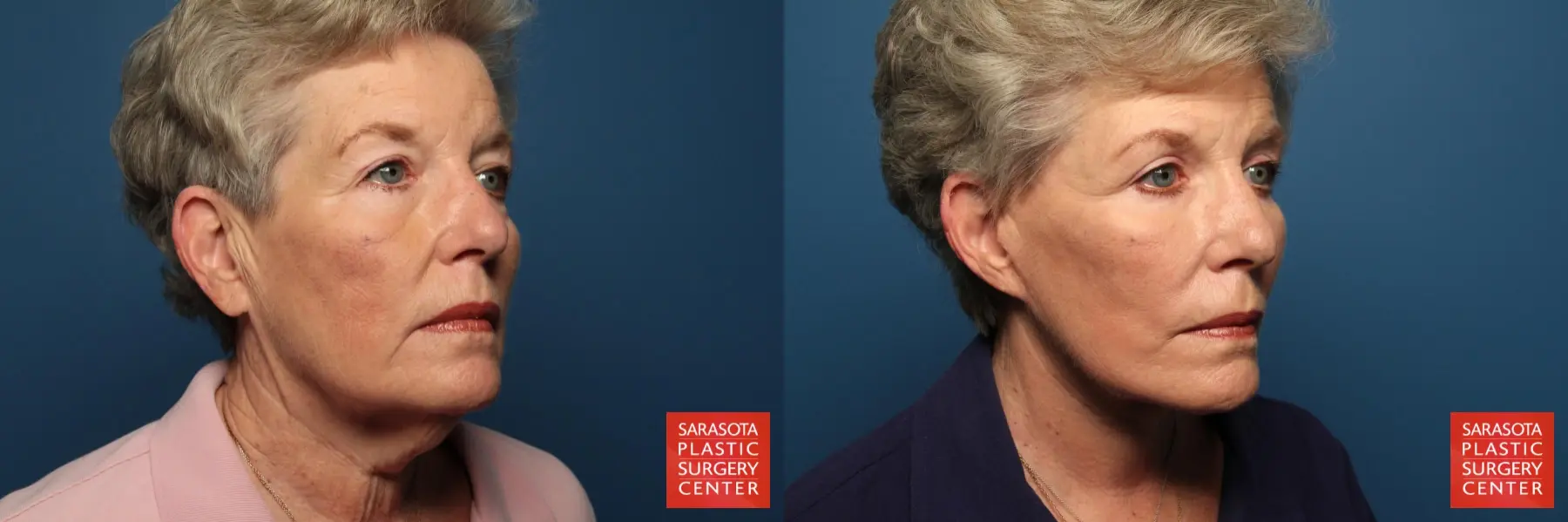 Facelift: Patient 43 - Before and After 2