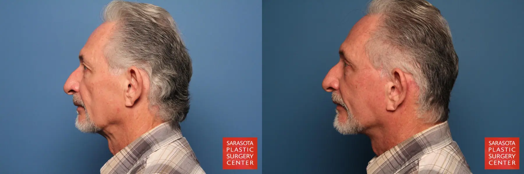 Facelift For Men: Patient 1 - Before and After 3