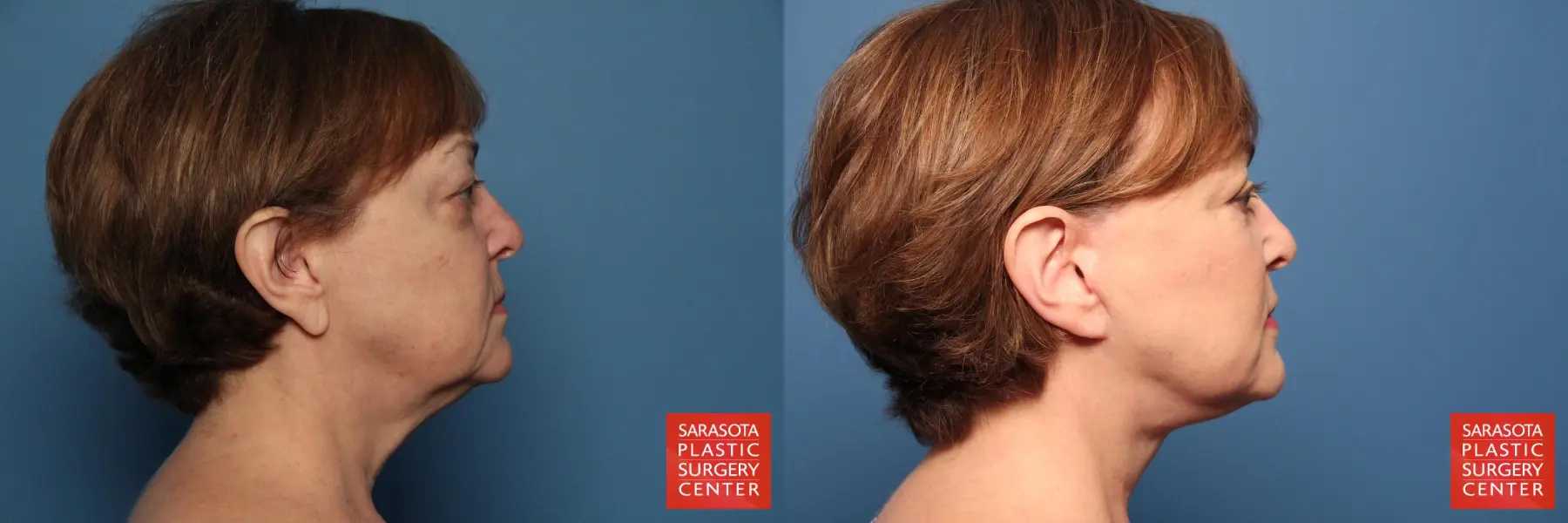 Facelift: Patient 104 - Before and After 3