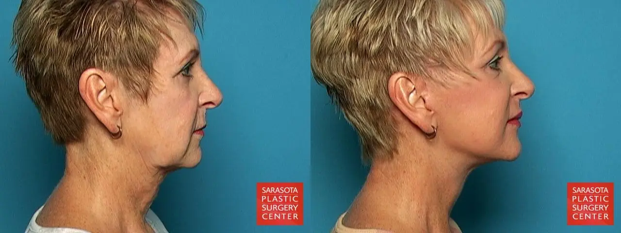 Sarasota Facelift  - Before and After 3