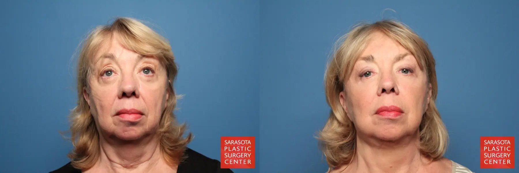 Facelift: Patient 29 - Before and After  