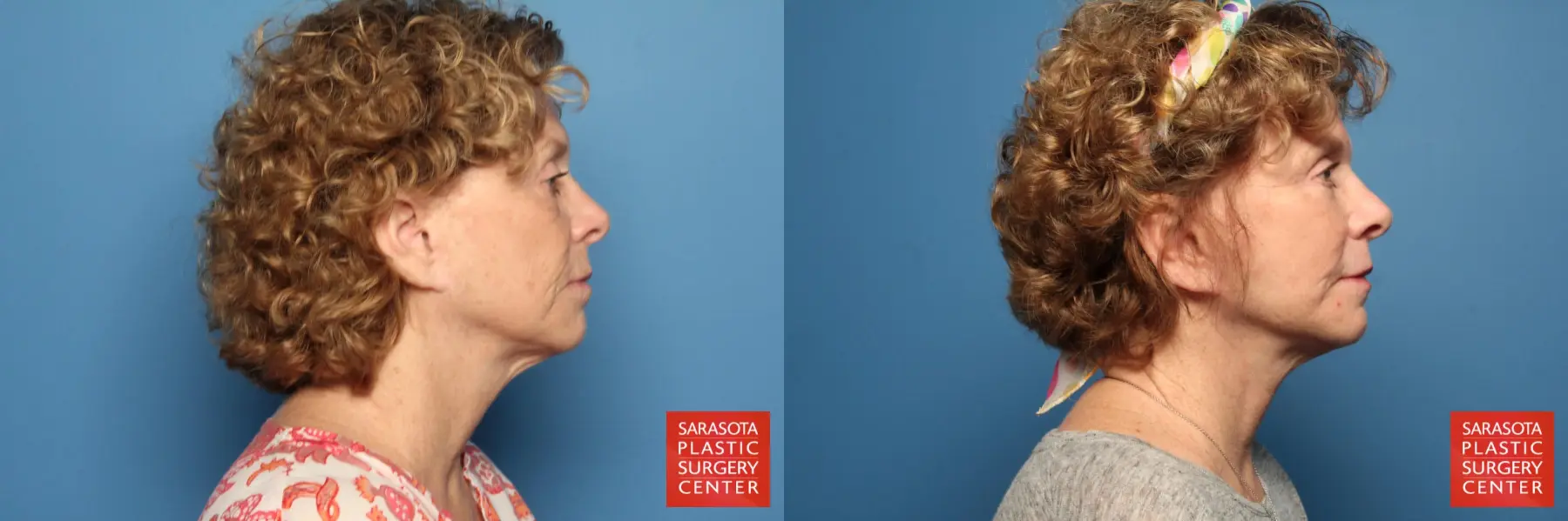Facelift: Patient 31 - Before and After 3