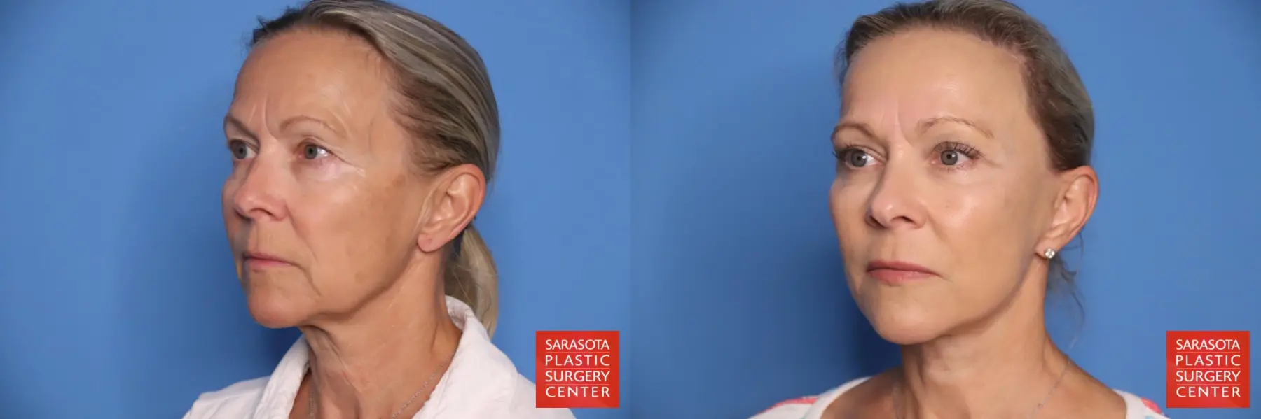 Facelift: Patient 54 - Before and After 2