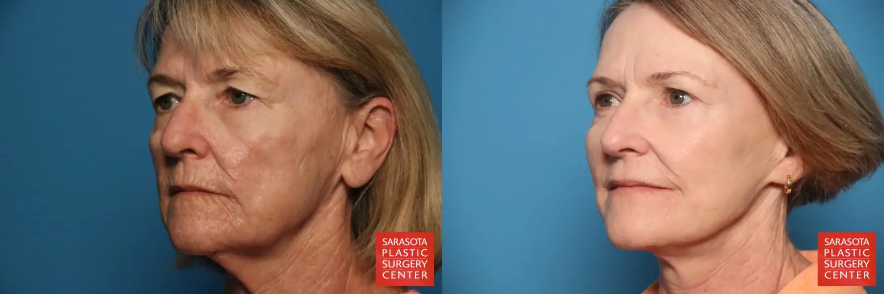 Facelift: Patient 64 - Before and After 2