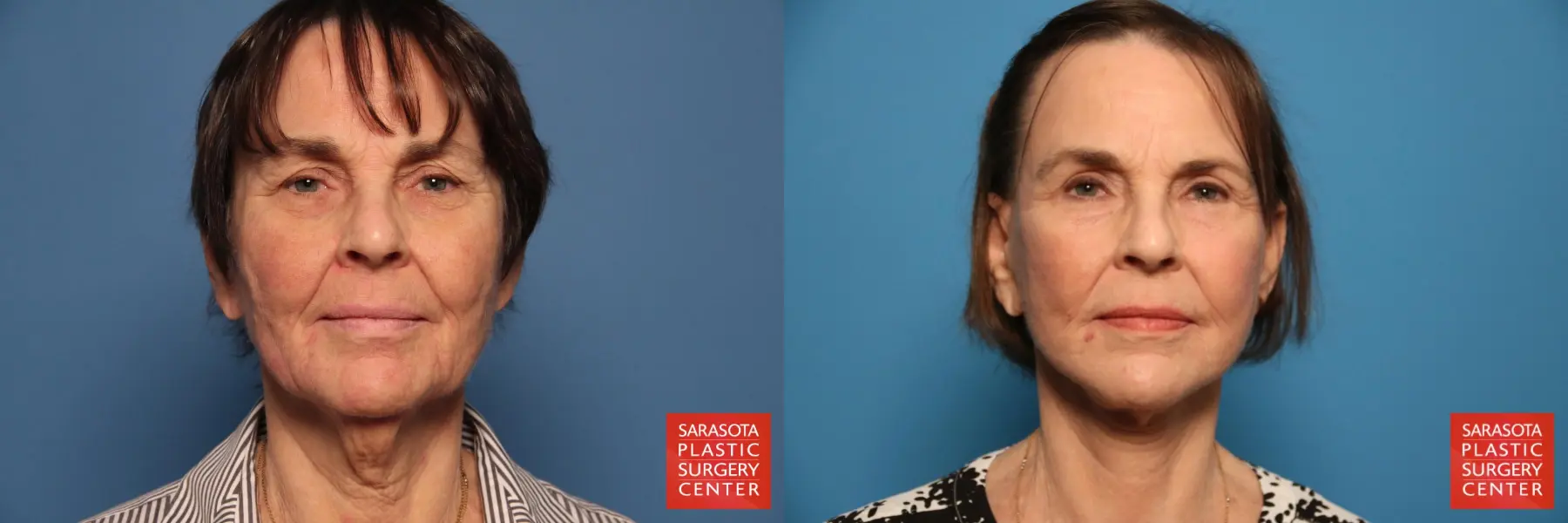 Facelift: Patient 60 - Before and After 1