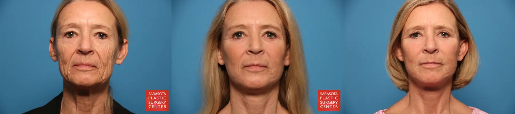 Facelift: Patient 13 - Before and After  