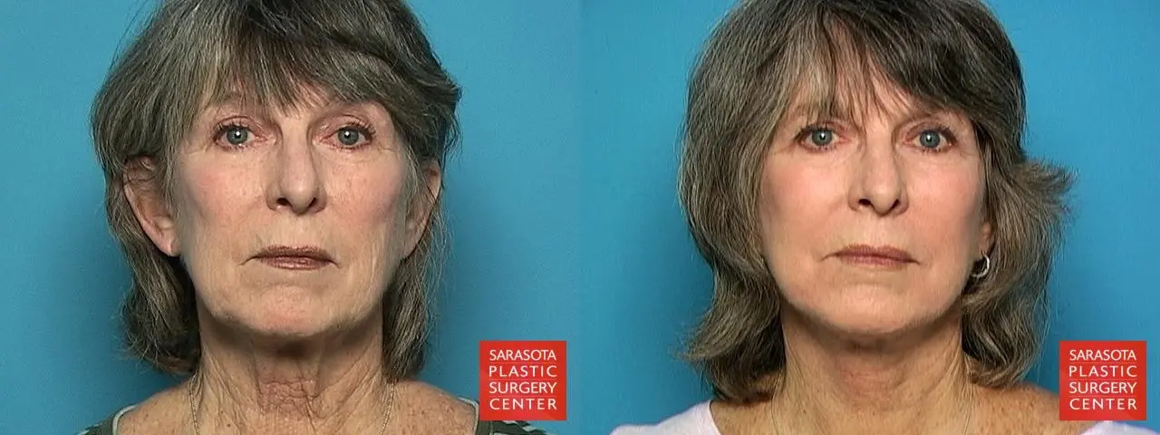 Facelift: Patient 19 - Before and After  