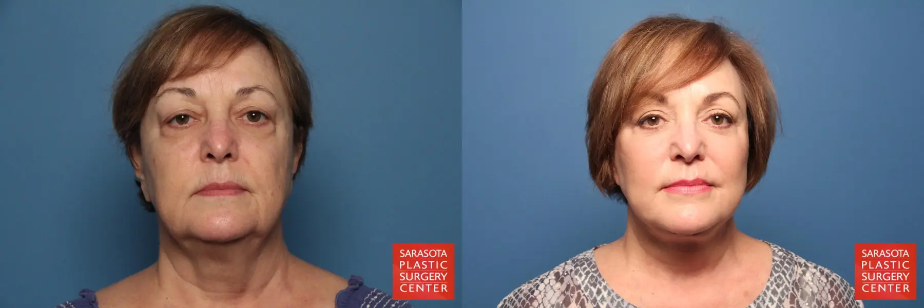 Facelift: Patient 104 - Before and After 1