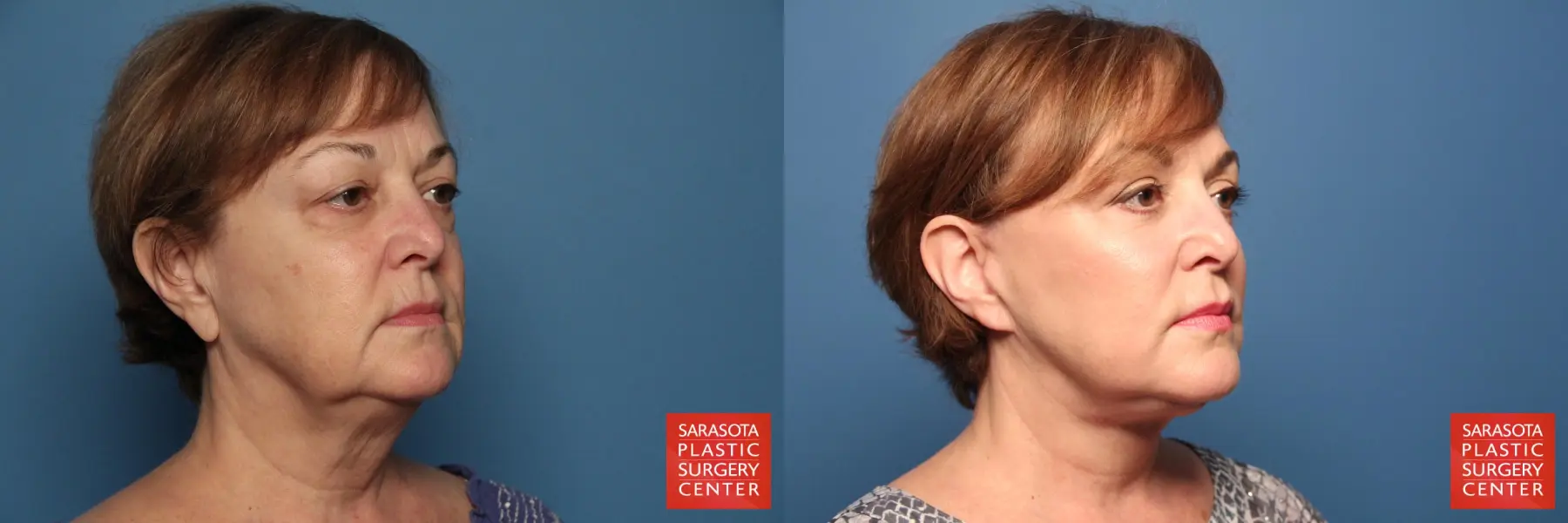 Facelift: Patient 104 - Before and After 2