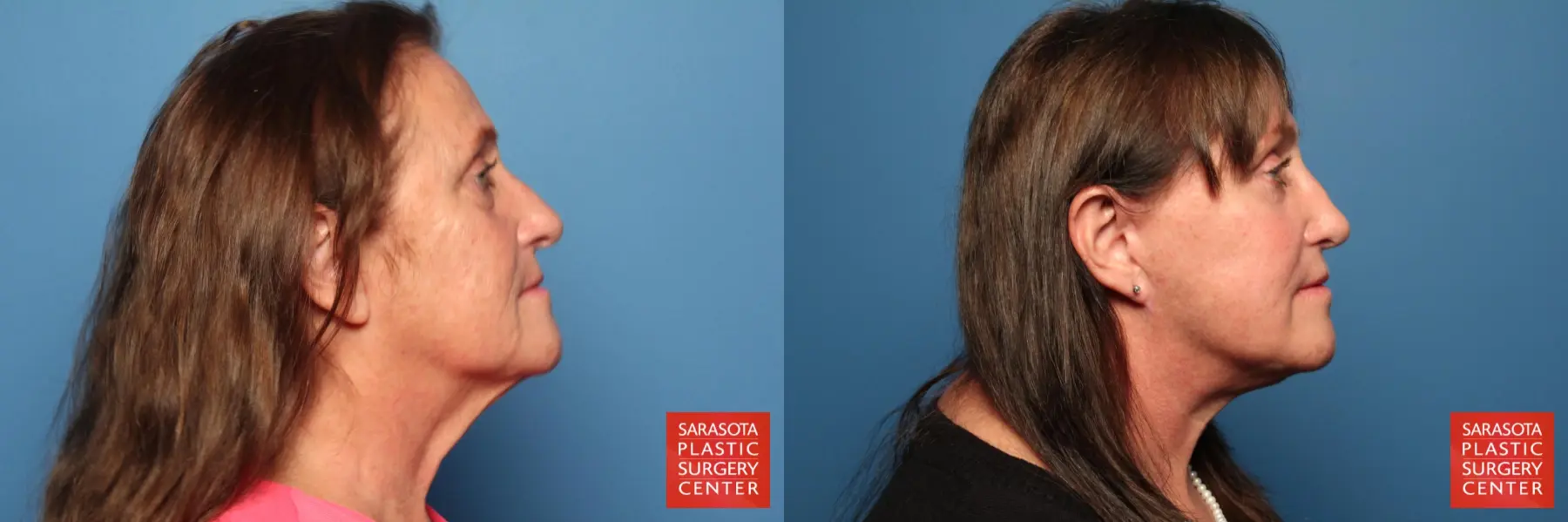 Facelift: Patient 16 - Before and After 3