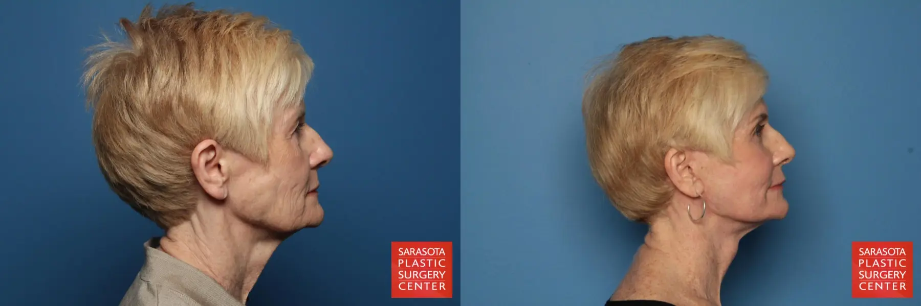 Facelift: Patient 37 - Before and After 5