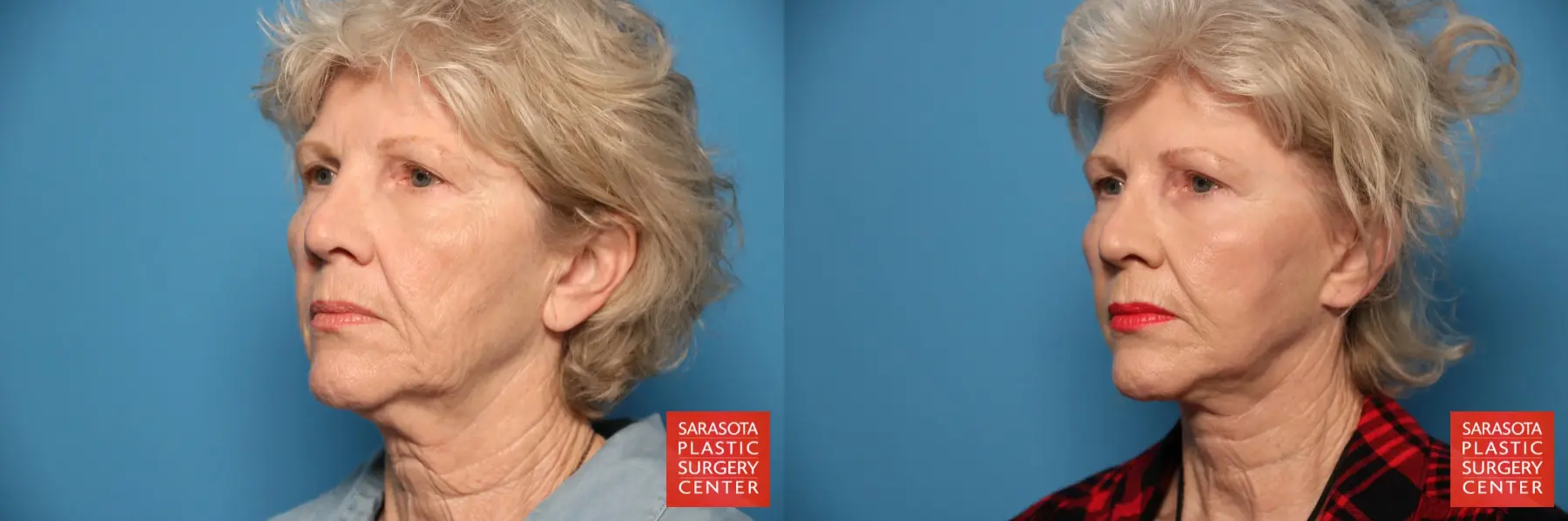 Facelift: Patient 22 - Before and After 4
