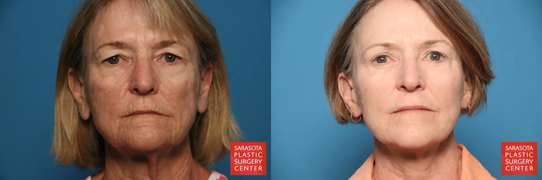 Facelift: Patient 64 - Before and After 1