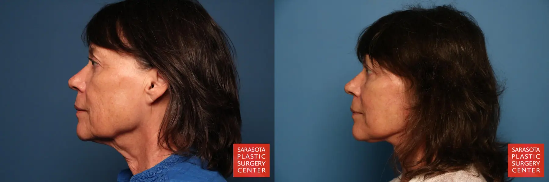 Facelift: Patient 15 - Before and After 3
