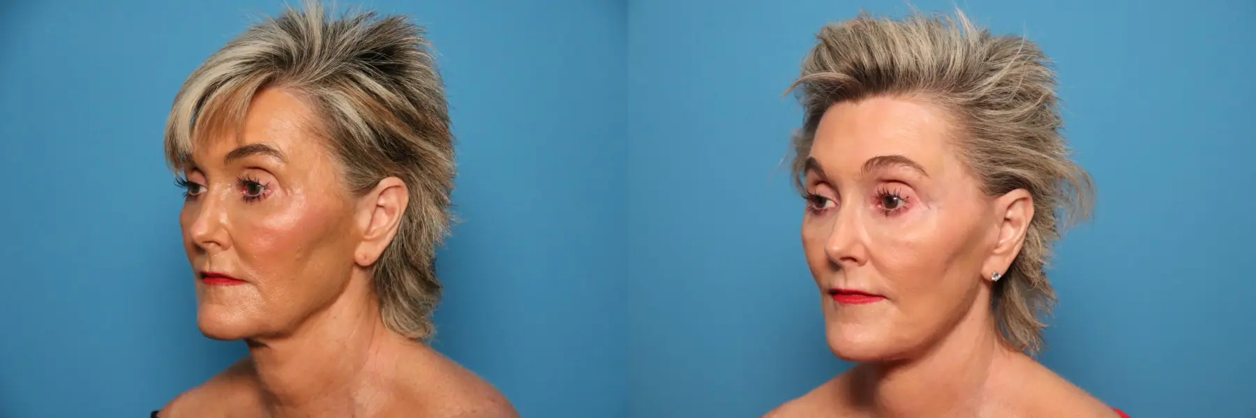 Mini Facelift: Patient 6 - Before and After 2