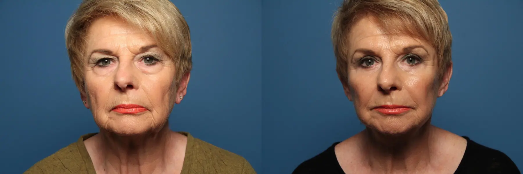 Facelift/Mini Facelift: Patient 2 - Before and After  