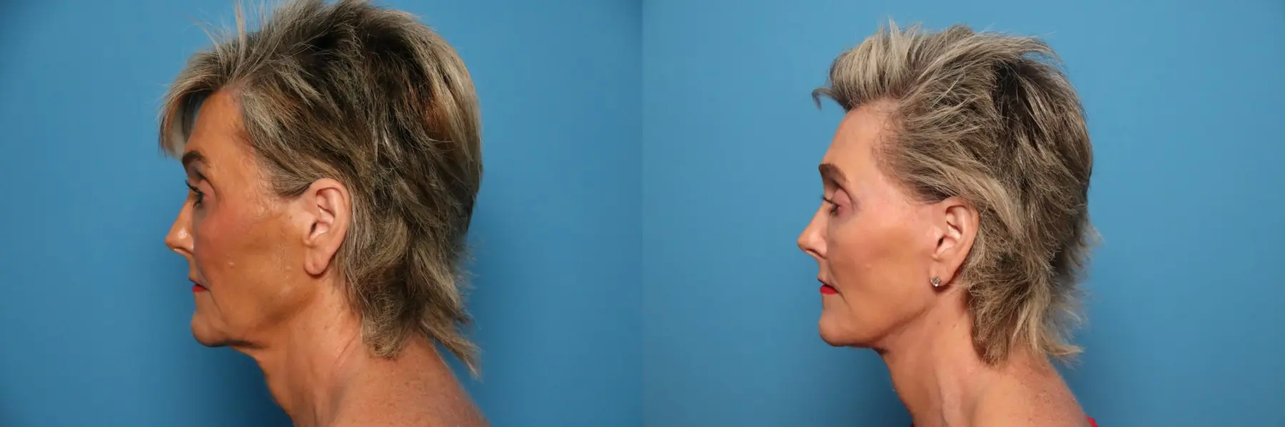 Mini Facelift: Patient 6 - Before and After 3