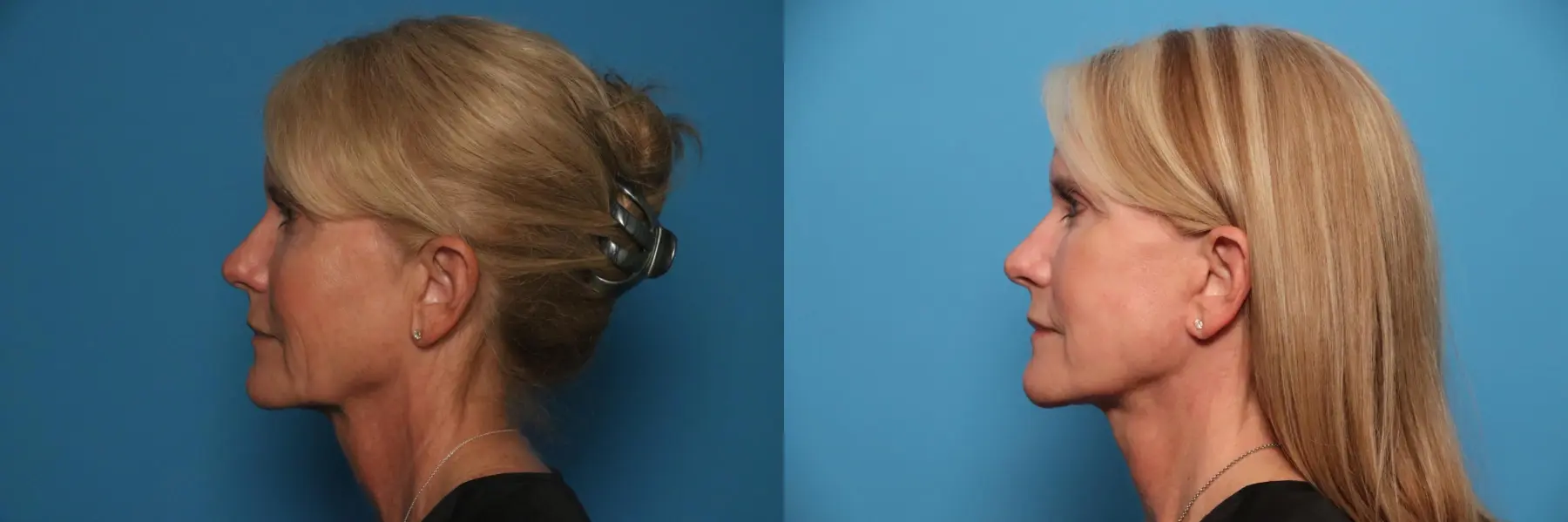 Mini Facelift: Patient 1 - Before and After 3