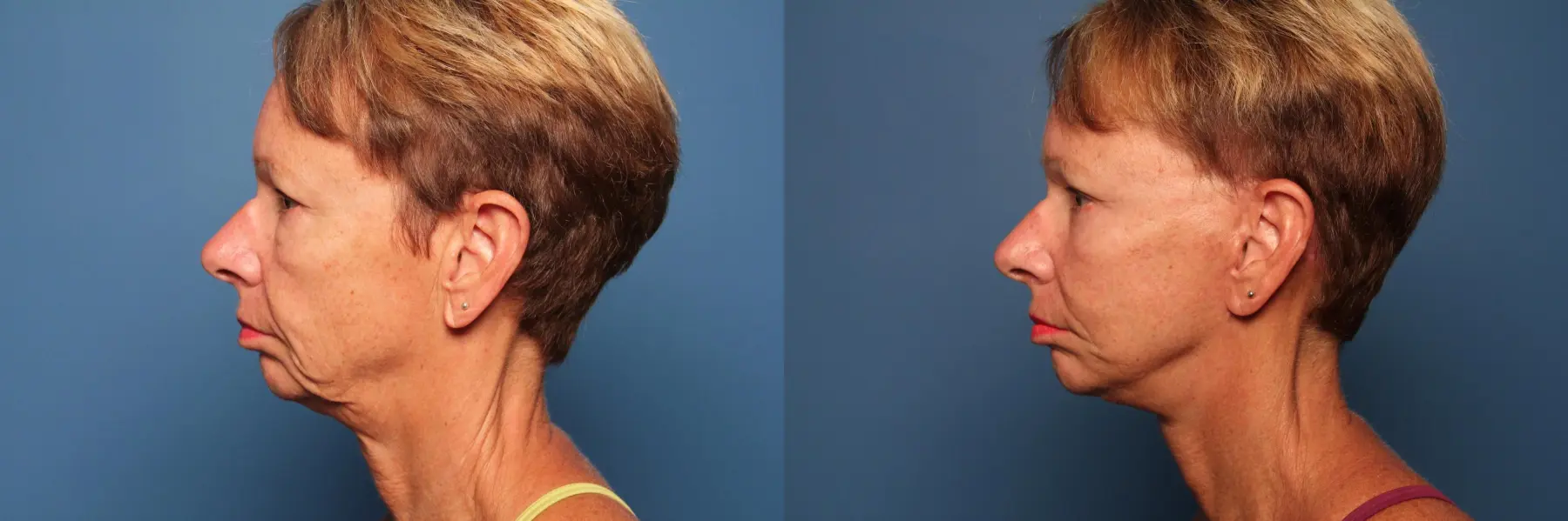 Mini Facelift: Patient 4 - Before and After 3