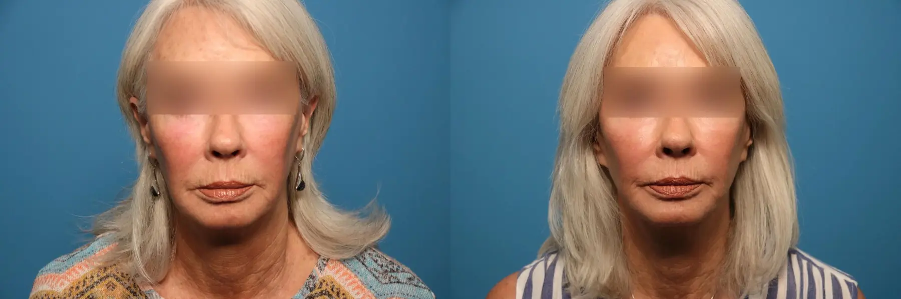 Mini Facelift: Patient 3 - Before and After 1