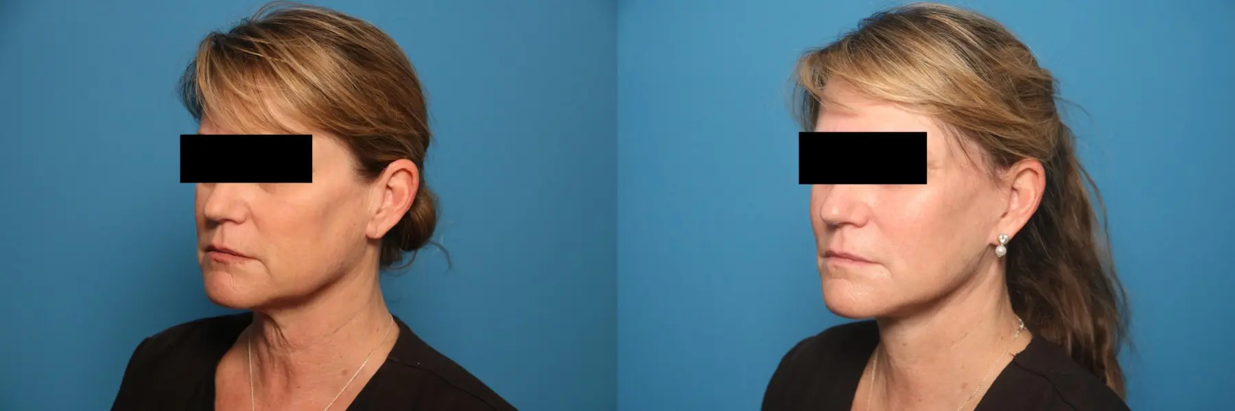Mini Facelift: Patient 7 - Before and After 2