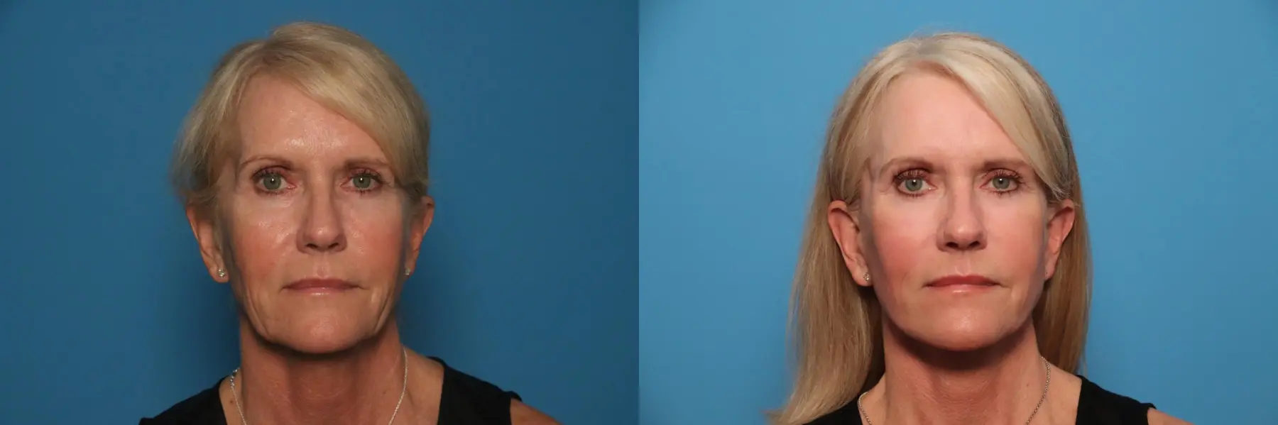 Mini Facelift: Patient 1 - Before and After 1