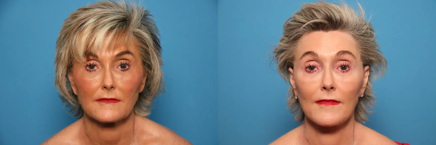 Facelift/Mini Facelift: Patient 6 - Before and After 1