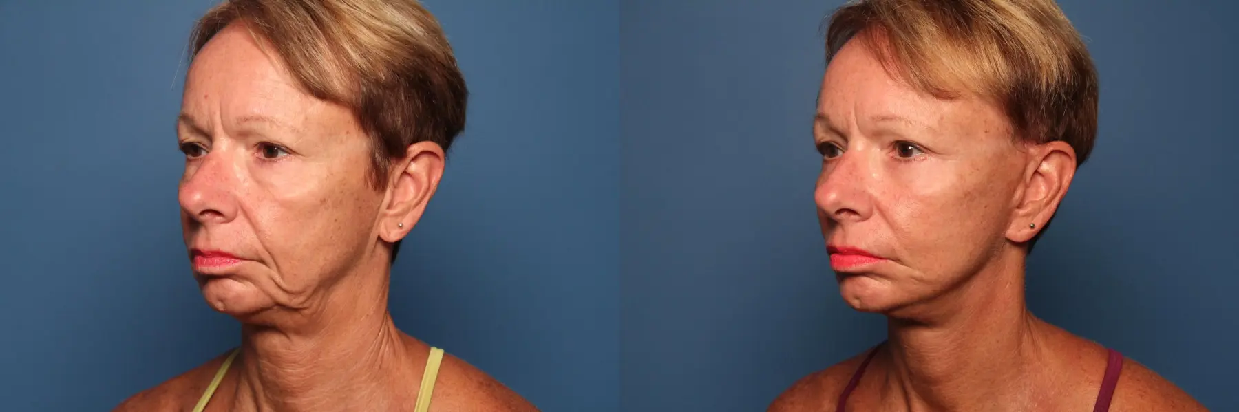 Mini Facelift: Patient 4 - Before and After 2