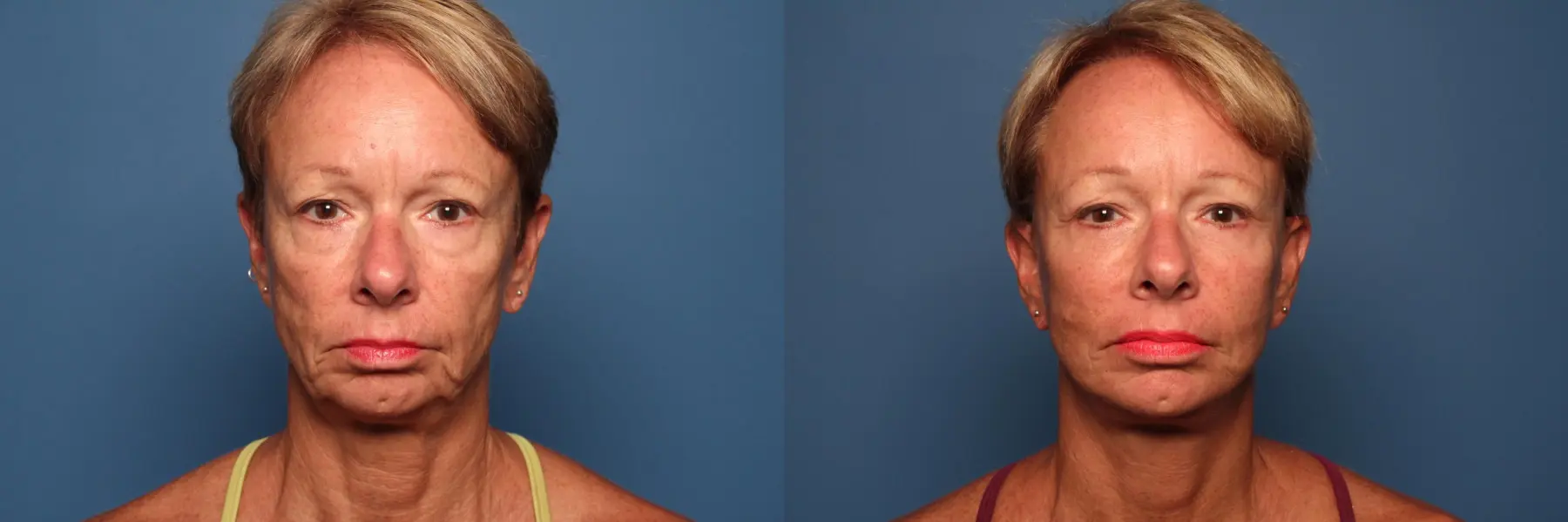 Mini Facelift: Patient 4 - Before and After  