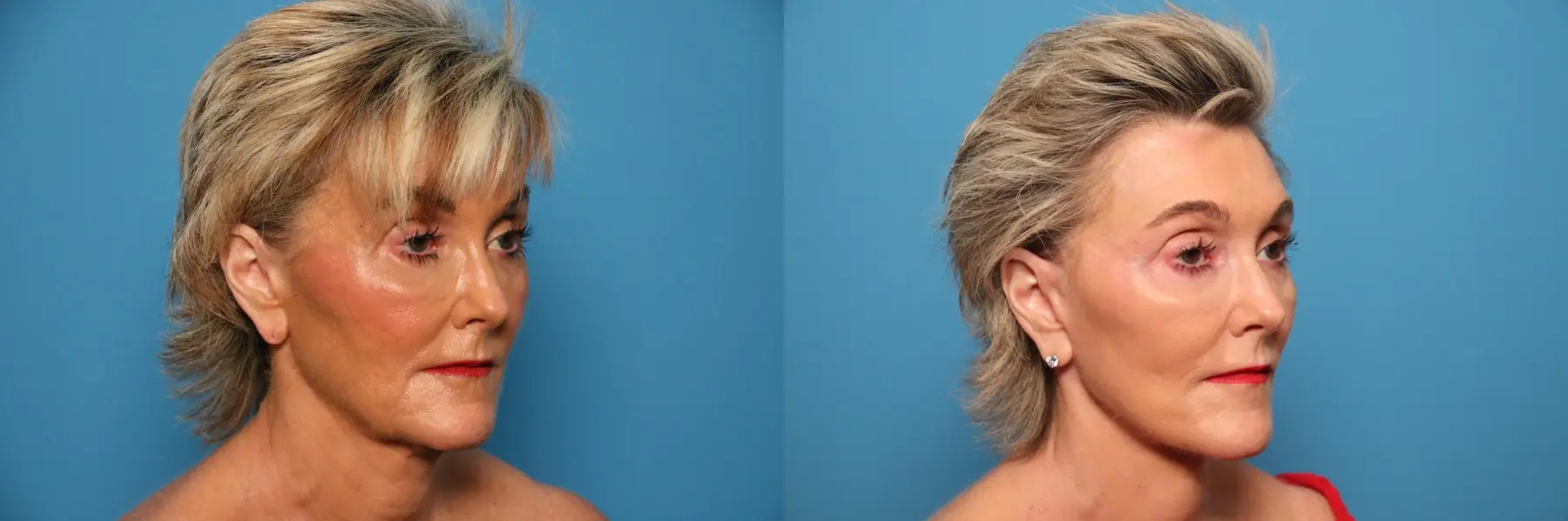 Mini Facelift: Patient 6 - Before and After 4